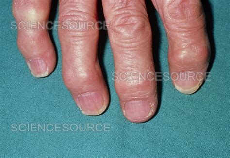 heberdens nodes surgery