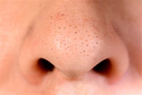Чёрные точки: что делать? | BIOSPACLINIC | Дзен