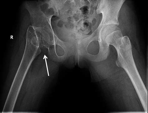 Case Report of Untreated Pediatric Femoral Neck Fracture with