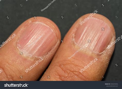 Vertical Ridges On Fingernails Symptoms Deficiency Stock Photo ...