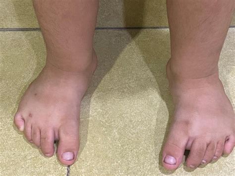 metatarsus adductus dr vidyasagar chandankere expert pediatric