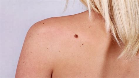 Папиллома: малозаметная угроза | MedAboutMe