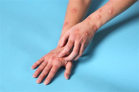 Signs and symptoms of Monkeypox and how to prevent it | Open Access ...