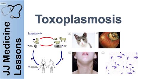 Toxoplasmosis | Acquired vs Congenital | Signs, Symptoms, Diagnosis and ...