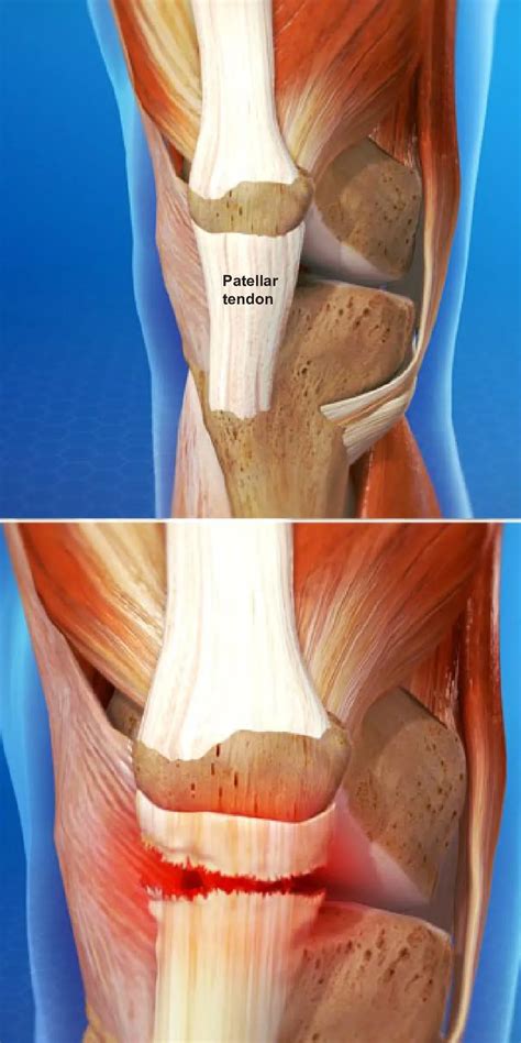 Patella Tendon Rupture | Orthopedic Surgery & Joint Replacement located
