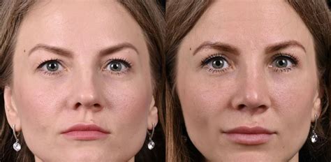 Блефаропластика: веки выше и взгляд моложе - Cosmetic-clinic