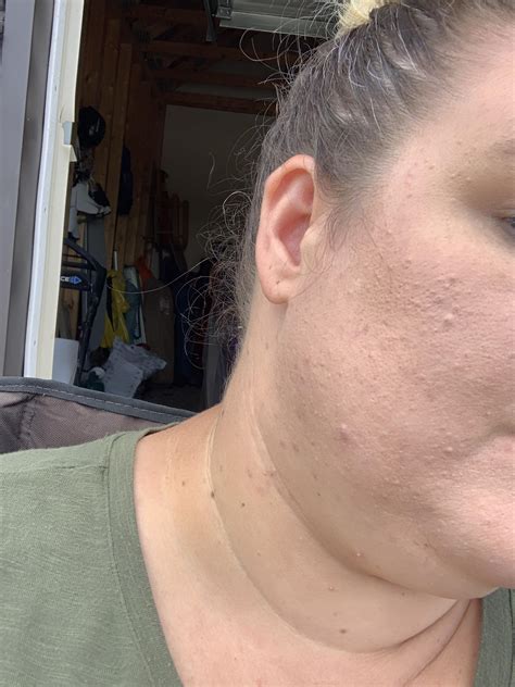 [Acne] How to get rid of these little bumps on my cheeks? : r