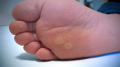Olho De Peixe No Pé Como Tirar Em Casa - Verruga plantar (olho de peixe no pé): o que é e como tirar