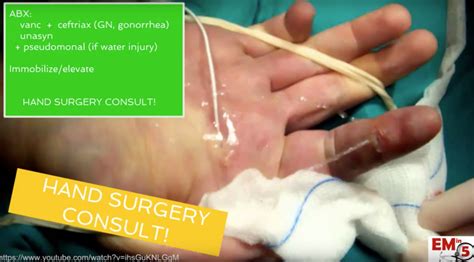 emDOCs.net – Emergency Medicine EducationEM in 5: Flexor Tenosynovitis ...