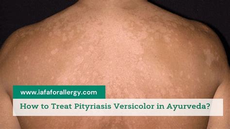 tinea versicolor treatment
