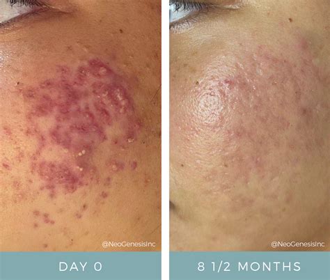 Effective Solutions for Acne and Maskne with NeoGenesis