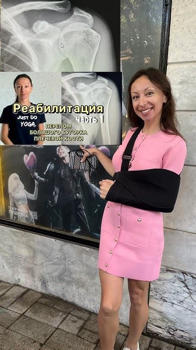 ⬆️#Перелом большого бугорка плечевой кости #Реабилитация #Упражнения # ...