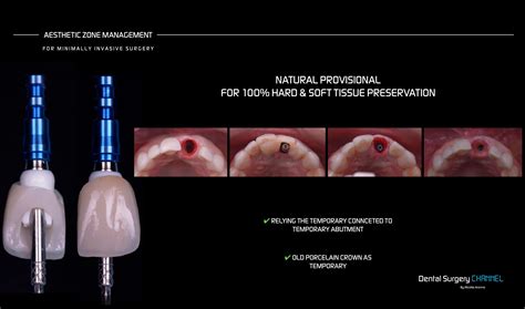 DECISION MAKING PROCESS IN THE AESTHETIC ZONE - dentalsurgerychannel.com
