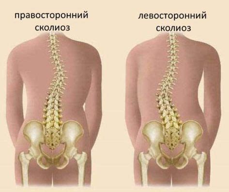 Правосторонний и левосторонний сколиоз в 2020 г | Сколиоз, Упражнения ...