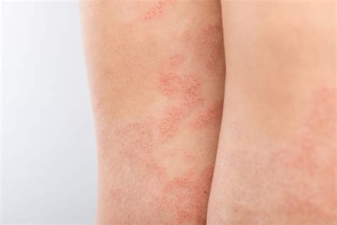 Eczema In Babies and Children | London Paediatrician