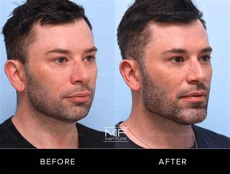 Jawline Filler for Men: Transformative Before and After Photos – Mabrie ...