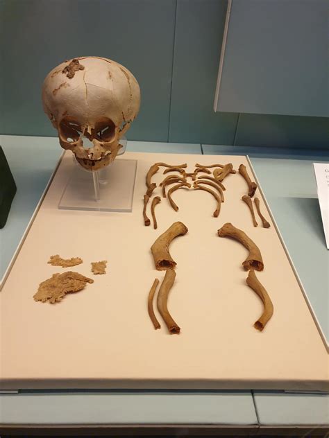 Osteogenesis Imperfecta : Pathophysiology and Treatment – My Endo Consult