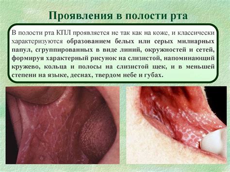Красный плоский лишай - презентация онлайн