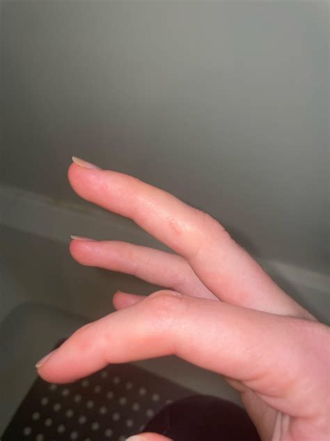 What are these little bumps on my fingers and toes? : r