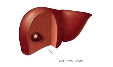 Гемангиома печени – симптомы, лечение, диета, причины
