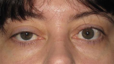Drooping Eyelid | Eyelid Ptosis | Eye looking smaller | Mr David Cheung ...