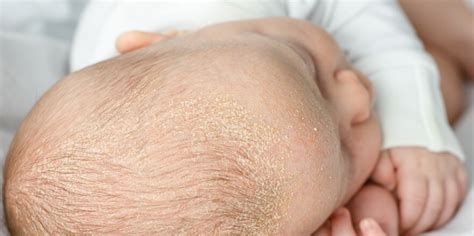 Piel atópica en bebés: cómo cuidarla | Pequeñín