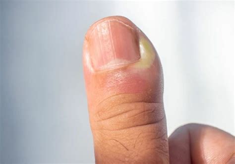 nail fold infection paronychia hand  nerve surgeon