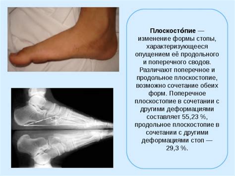 Осанка. Предупреждение плоскостопия.