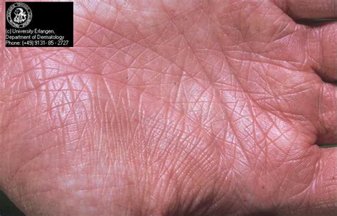 Atopic Dermatitis Palms