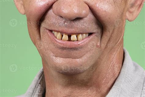 Part of the face with ugly yellow and sparse teeth. Dental problems of ...