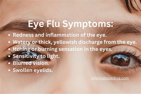 Understanding Eye Flu: Treatment and Home Remedies - INFORMATOPEDIYA