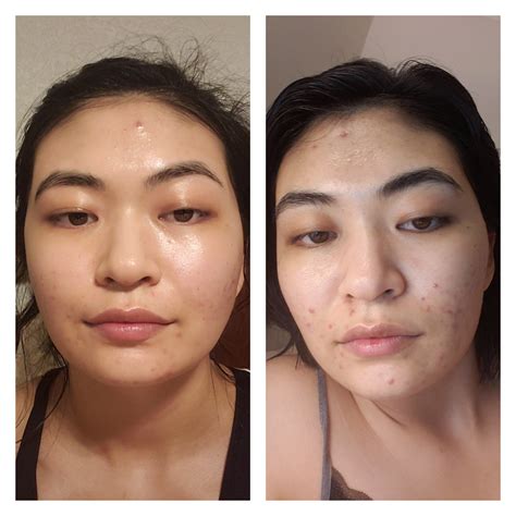 Tretinoin Before After, Before and after month 2 on 05% tretinoin cream ...