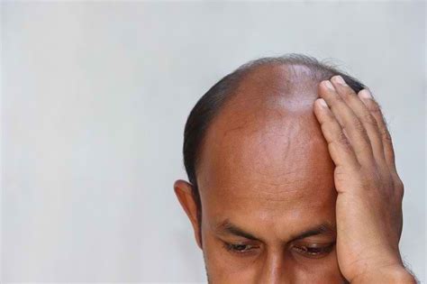 botak umur 2 rambut tipis - Christopher Duncan