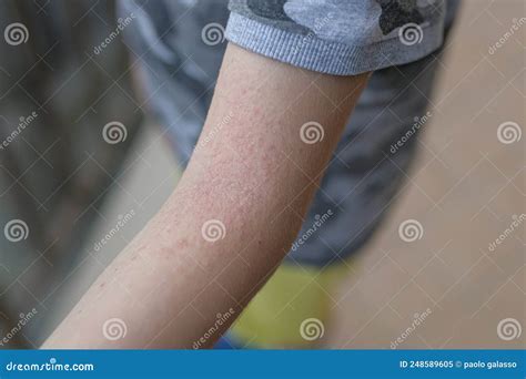 Dermatitis Of Rash , Allergy Rash Royalty-Free Stock Photography ...