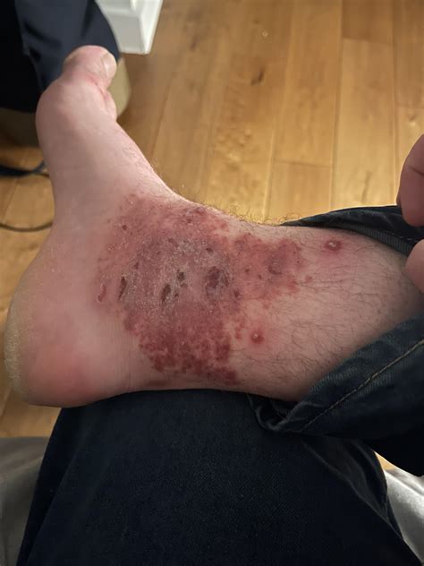 I have psoriasis, but had a major flare up a couple months ago. This