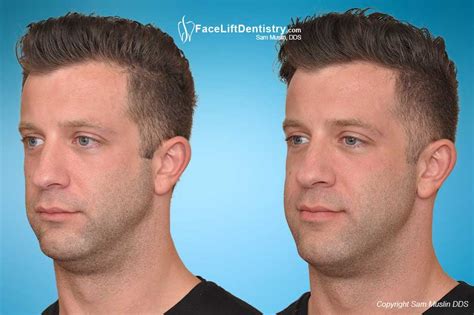 how to fix receding chin without surgery