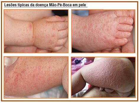 Pe Mao E Boca Inicio - Doença Mão Pé Boca - Dra keilla Freitas