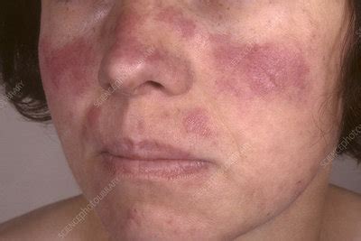 Systemic lupus erythematosus - Stock Image - C038/4500 - Science Photo ...
