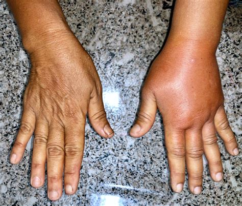 What is Lymphedema? - OncoPelvic PT