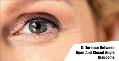 difference  open  closed angle glaucoma skipper eyeq
