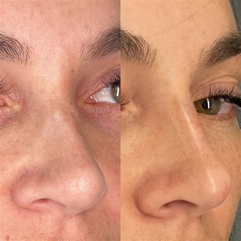 Nonsurgical Rhinoplasty - Designer Aesthetics by Dr. Jarrett Schanzer