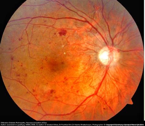 What Is Diabetic Retinopathy? | Annan Retina Eye Center in Houston, Texas