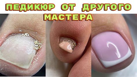 Что такое птеригий на ногтях фото