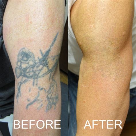 Tattoo Removal: Before/After Before and After Photos