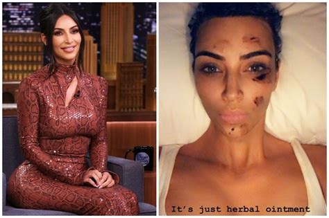 Kim Kardashian's Psoriasis Breakout: Everything You need to Know About ...