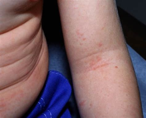 Scarlet Fever - Causes, Symptoms, Long Term Effects, Treatment