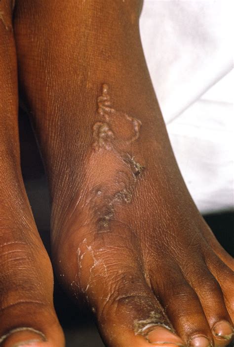 Hookworm Infection - Infectious Diseases - MSD Manual Professional Edition
