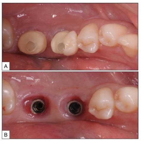 Local Oxygen-Based Therapy (blue®m) for Treatment of Peri-Implant