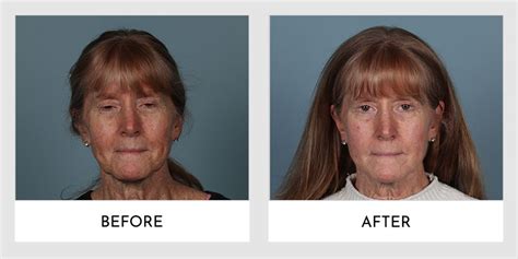 Forever Young Bbl Laser Treatment Before and After | Aesthetic MdR