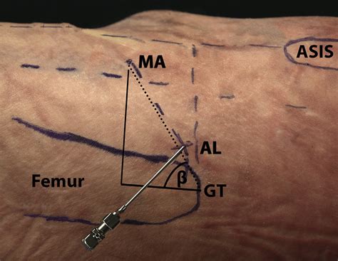 Location of the anterolateral approach (AL) in relation to the ASIS and ...